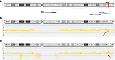 NUP214 fusion genes in acute leukemias: genetic characterization of rare cases